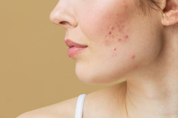 Comment entretenir sa peau quand on a de l’acné ?